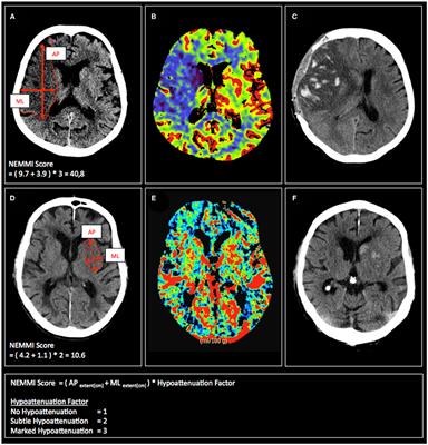 Computed Tomography Based Score of Early Ischemic Changes Predicts Malignant Infarction